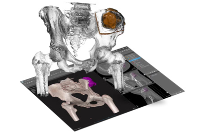 3D시스템즈, FDA 510(k) 승인 획득... 정형외과 플랫폼 청소년까지 확대